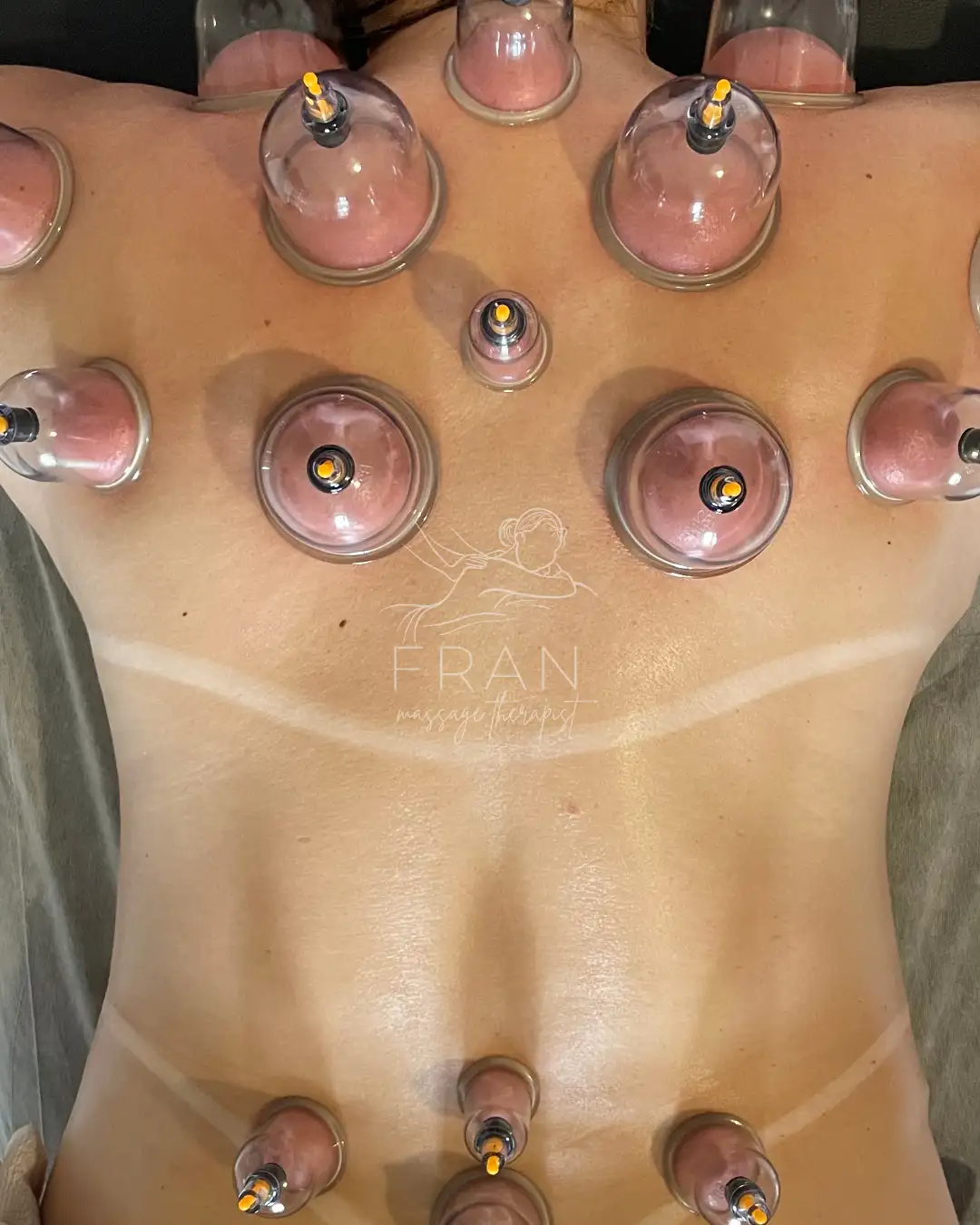 cupping-massage-forest-gate-london.webp