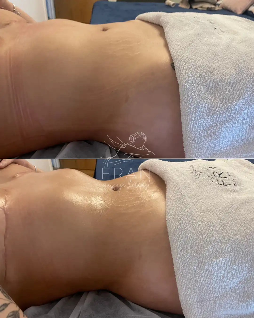 lymphatic-drainage-after-surgery-london.webp