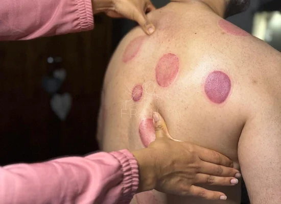 cupping-therapy-back-pain-relief-london.webp