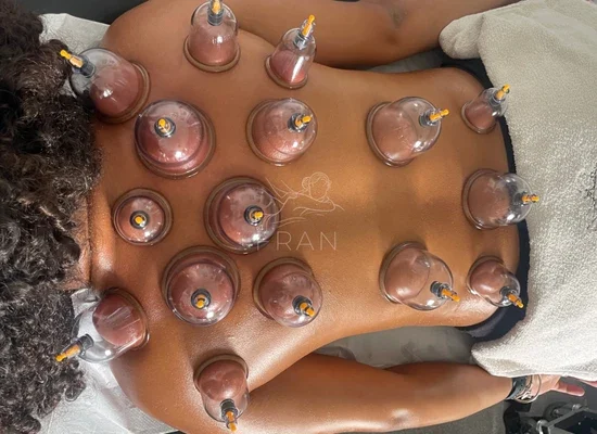 cupping-therapy-marks-fading-london.webp
